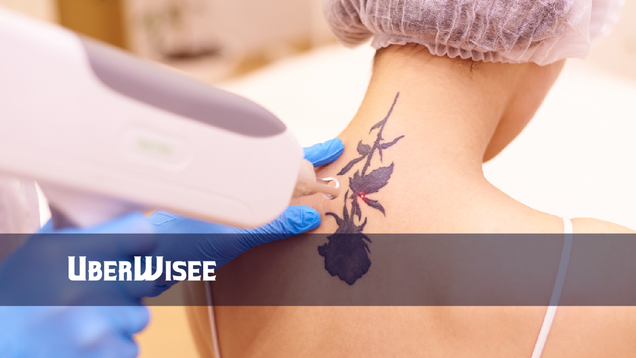 Tattoo Removal