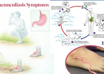 “7 Warning Dracunculiasis Symptoms You Must Know” 20 Dracunculiasis Symptoms
